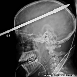 Radiografía del cerebro de Nasser Lopez atravesado por un arpón